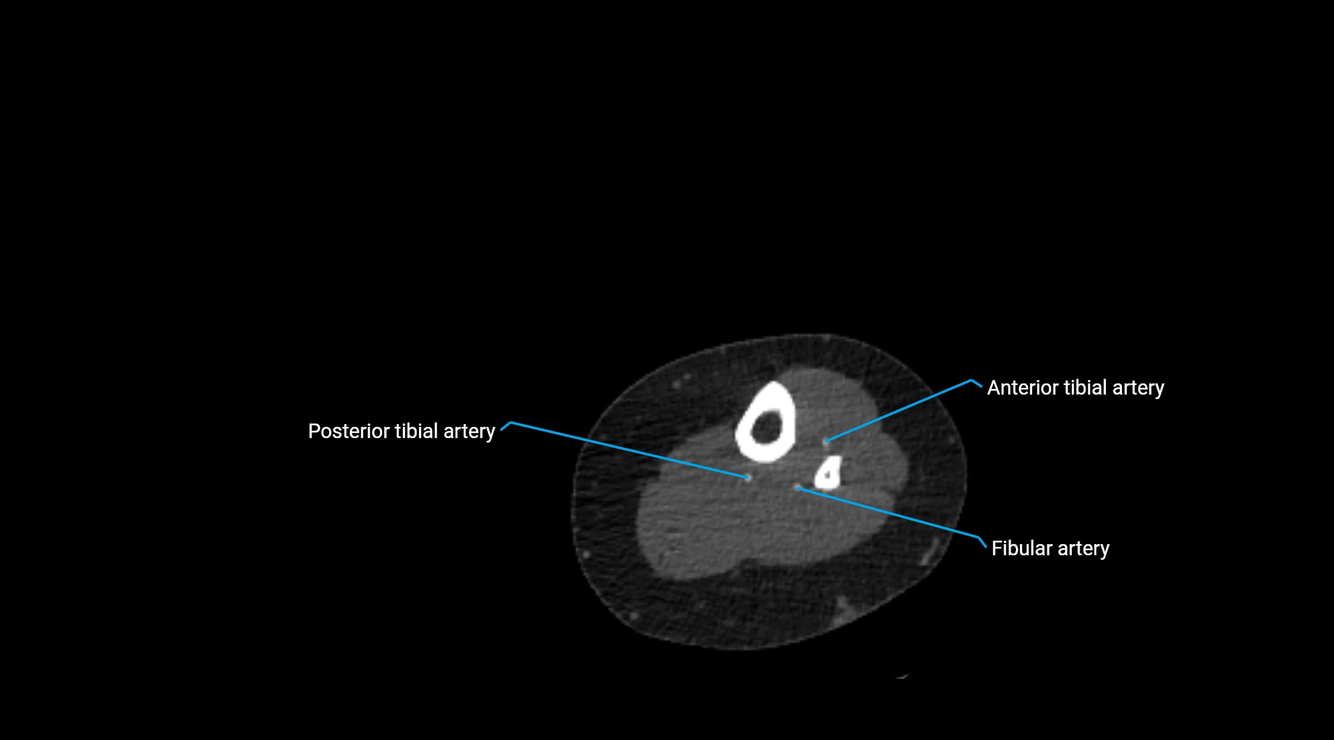 CTA lower limb cross sectional anatomy labelled image _215.webp